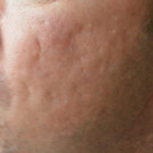 Micro-Needling with Platelet Rich Plasma Patient 40468 Photo 1