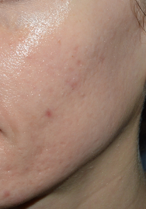Micro-Needling with Platelet Rich Plasma Patient 40831 Photo 2