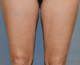 Velashape Patient 93673 Photo 2