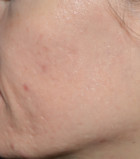 Micro-Needling with Platelet Rich Plasma Patient 23250 Photo 2