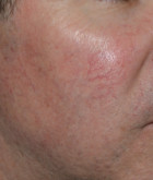 IPL / Skin Rejuvenation Patient 79196 Photo 1