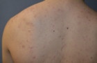 Micro-Needling with Platelet Rich Plasma Patient 29123 Photo 2