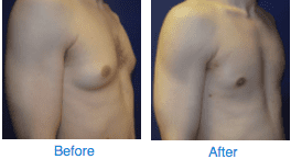 Gynecomastia Before & After photo