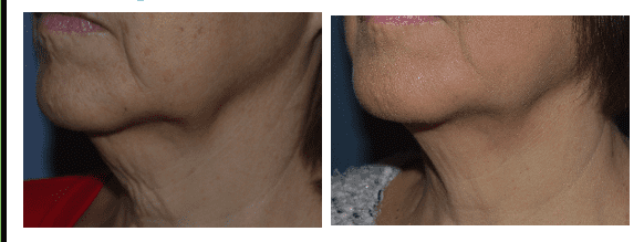 A before and after image set of a woman that underwent a Thermage CPT® procedure
