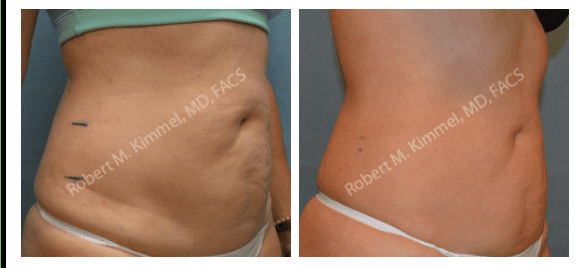 a before and after image set of a woman that underwent a Liposonix procedure