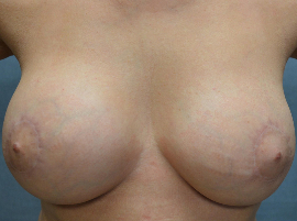Breast Lift Patient 53740 Photo 4