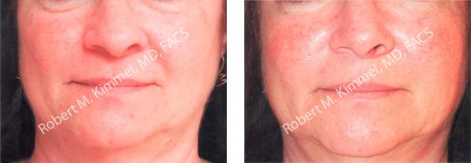 woman's face before and after fat injection stem cell makeover
