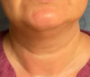 Liposuction Patient 67124 Photo 1