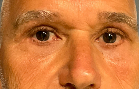 Blepharoplasty Patient 38458 Photo 2