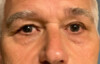 Blepharoplasty Patient 38458 Photo 1