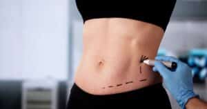 Professional surgeon performing liposuction on woman’s abdominal area, concept of body contouring and fat reduction surgery.