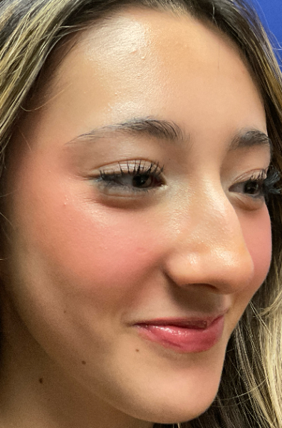 Rhinoplasty Patient 88349 Photo 1