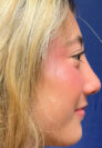 Rhinoplasty Patient 61303 Photo 2