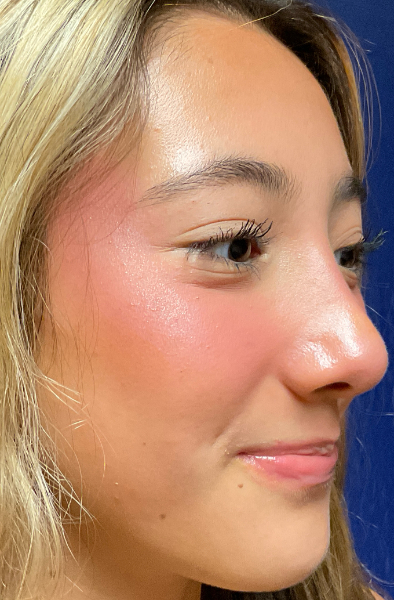 Rhinoplasty Patient 88349 Photo 2