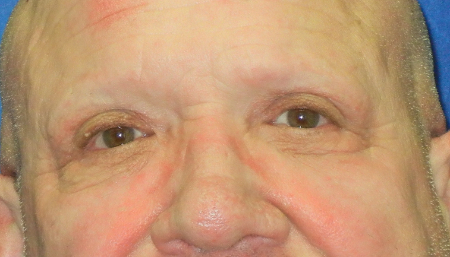 Blepharoplasty Patient 40081 Photo 2
