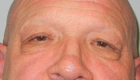 Blepharoplasty Patient 40081 Photo 1