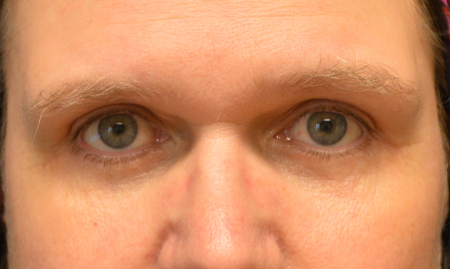 Blepharoplasty Patient 44026 Photo 2