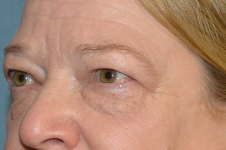Blepharoplasty Patient 18379 Photo 1