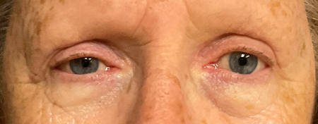 Blepharoplasty Patient 25414 Photo 2
