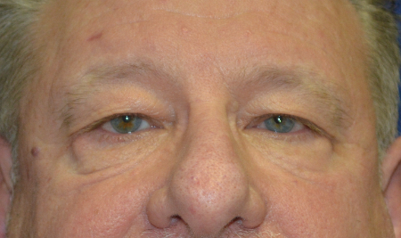Blepharoplasty Patient 86916 Photo 2