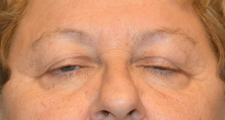 Blepharoplasty Patient 35146 Photo 1