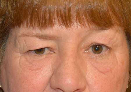 Blepharoplasty Patient 10873 Photo 1