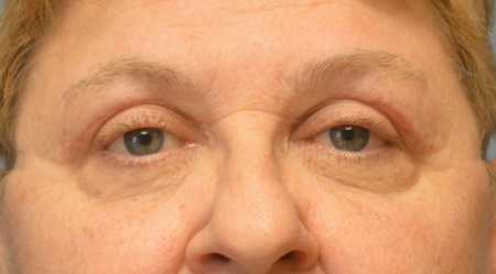 Blepharoplasty Patient 35146 Photo 2