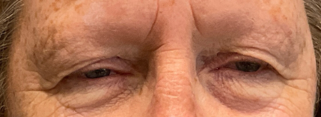 Blepharoplasty Patient 25414 Photo 1