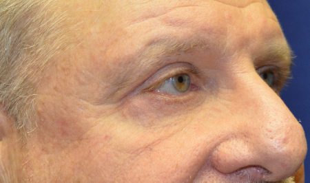 Blepharoplasty Patient 85729 Photo 2