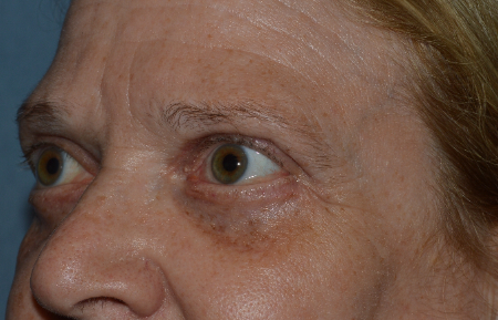 Blepharoplasty Patient 18379 Photo 2