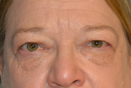 Blepharoplasty Patient 34149 Photo 1