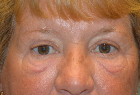 Blepharoplasty Patient 10873 Photo 2