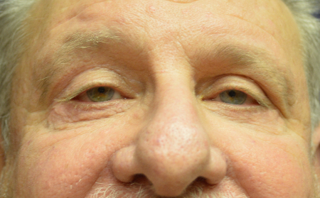 Blepharoplasty Patient 86916 Photo 1