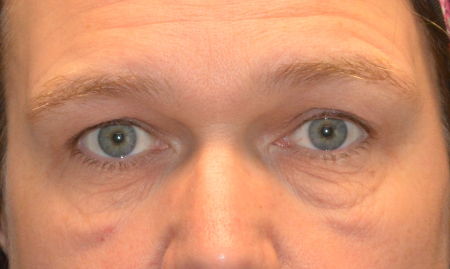 Blepharoplasty Patient 44026 Photo 1