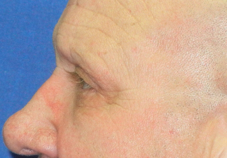 Blepharoplasty Patient 40081 Photo 4