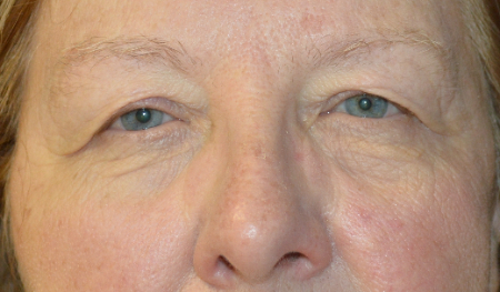 Blepharoplasty Patient 37890 Photo 2
