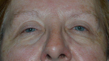Blepharoplasty Patient 37890 Photo 1