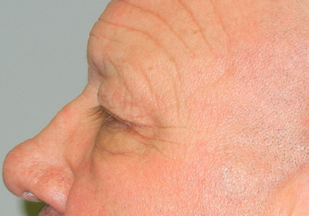 Blepharoplasty Patient 40081 Photo 3