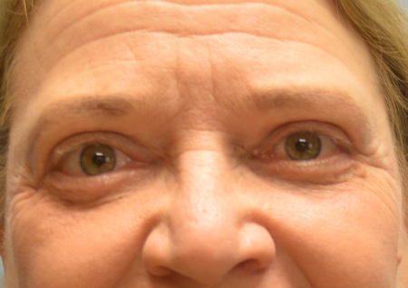 Blepharoplasty Patient 34149 Photo 2
