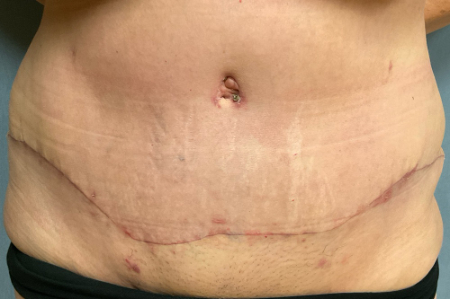 Abdominoplasty Patient 57721 Photo 2