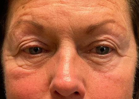 Blepharoplasty Patient 81690 Photo 1