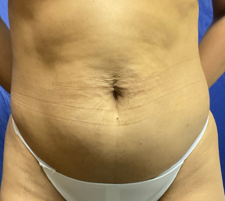 Abdominoplasty Patient 56032 Photo 1