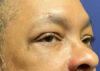 Blepharoplasty Patient 77914 Photo 2