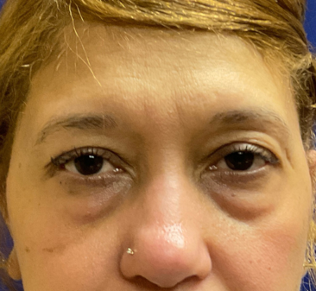 Blepharoplasty Patient 28348 Photo 1