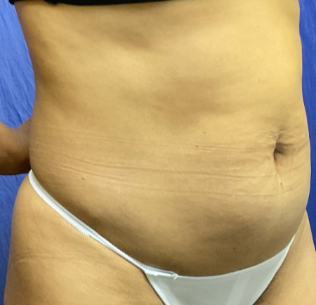 Abdominoplasty Patient 58983 Photo 1
