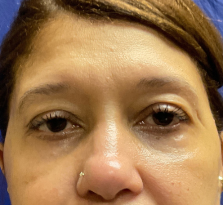 Blepharoplasty Patient 28348 Photo 2