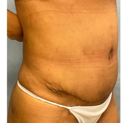 Abdominoplasty Patient 58983 Photo 2