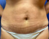 Abdominoplasty Patient 54080 Photo 2
