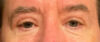 Blepharoplasty Patient 66863 Photo 2
