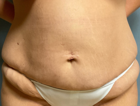 Abdominoplasty Patient 72645 Photo 1